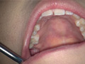 歯フェチ！本物の歯治療映像【抜歯】 ミランダ サンプル画像8