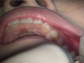 歯フェチ！本物の歯治療映像【抜歯】 ミランダ サンプル画像9