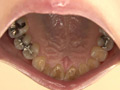 [fetishjapan-0915] 歯フェチ！本物の歯治療映像 小百合 前沢小百合のキャプチャ画像 2