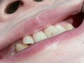 [fetishjapan-0915] 歯フェチ！本物の歯治療映像 小百合 前沢小百合のキャプチャ画像 3