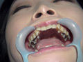 歯フェチ！本物の歯治療映像 小百合
