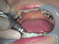 [fetishjapan-0915] 歯フェチ！本物の歯治療映像 小百合 前沢小百合のキャプチャ画像 9