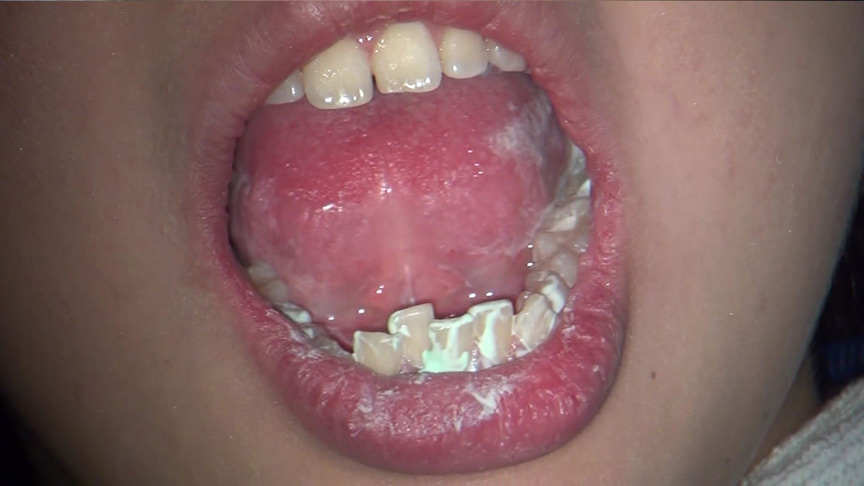 歯フェチ！本物歯治療映像色素沈着研磨除去＆歯石除去クリーニング 梅原葵