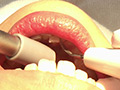 歯フェチ！本物歯治療映像色素沈着研磨除去＆歯石除去 サンプル画像2