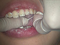 歯フェチ！本物歯治療映像色素沈着研磨除去＆歯石除去 サンプル画像4