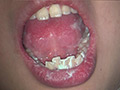 歯フェチ！本物歯治療映像色素沈着研磨除去＆歯石除去 サンプル画像5