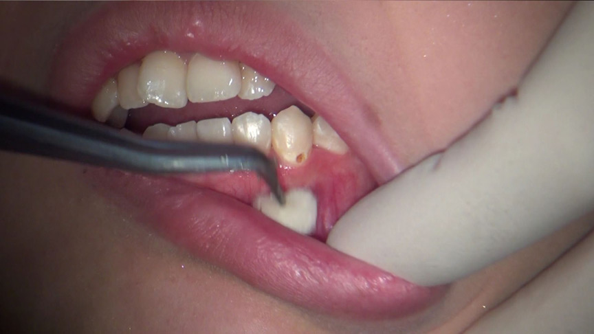 歯フェチ！本物歯治療映像虫歯掘削処置 堀越まき-2