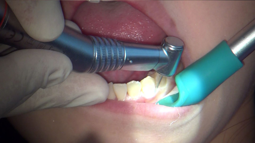 歯フェチ！本物歯治療映像虫歯掘削処置 堀越まき-5