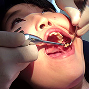 歯フェチ！本物歯治療映像虫歯掘削処置 堀越まき