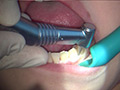 歯フェチ！本物歯治療映像虫歯掘削処置 堀越まき サンプル画像5