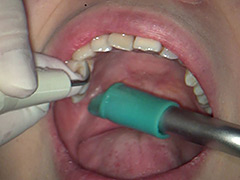 口腔：歯フェチ！本物歯科映像 歯石除去 えみ