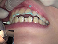 [fetishjapan-0939] 歯フェチ！本物歯科映像 歯石除去 えみ エミのキャプチャ画像 2