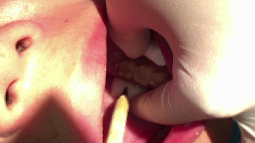 本物歯科治療映像 左下6，7番銀歯治療 星野桃子-3