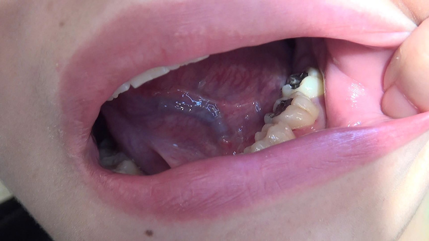 本物歯科治療映像 左下6，7番銀歯治療 星野桃子-5