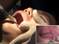 本物歯科治療映像 左下6，7番銀歯治療 星野桃子 サンプル画像1