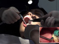 本物歯科治療映像 左下6，7番銀歯治療 星野桃子 サンプル画像4