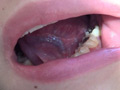 本物歯科治療映像 左下6，7番銀歯治療 星野桃子 サンプル画像5