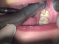 本物歯科治療映像 左下6，7番銀歯治療 星野桃子 サンプル画像6