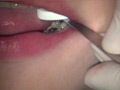 本物歯科治療映像 左下6，7番銀歯治療 星野桃子 サンプル画像9