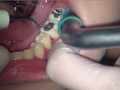 本物歯科治療映像 左下6，7番銀歯治療 星野桃子 サンプル画像10