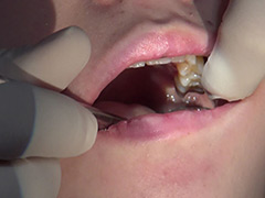 口腔：歯フェチ！本物歯科治療映像 親知らず抜歯 芹沢かえで