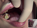 歯フェチ！本物歯科治療映像 親知らず抜歯 芹沢かえで サンプル画像2