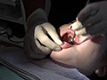 歯フェチ！本物歯科治療映像 親知らず抜歯 芹沢かえで...thumbnai3