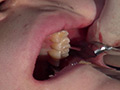 歯フェチ！本物歯科治療映像 親知らず抜歯 芹沢かえで...thumbnai5