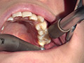 [fetishjapan-0971] 歯フェチ！本物歯科治療映像 井野紅葉のキャプチャ画像 4