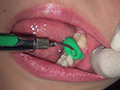 歯フェチ！本物歯科治療映像 安田ななは サンプル画像4