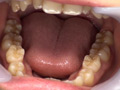 歯観察 放置崩壊歯をいじくってみた涼宮凛 サンプル画像4