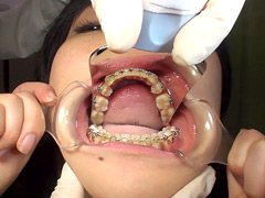 口腔ドキュメント 歯列矯正中の女 美紀・21歳