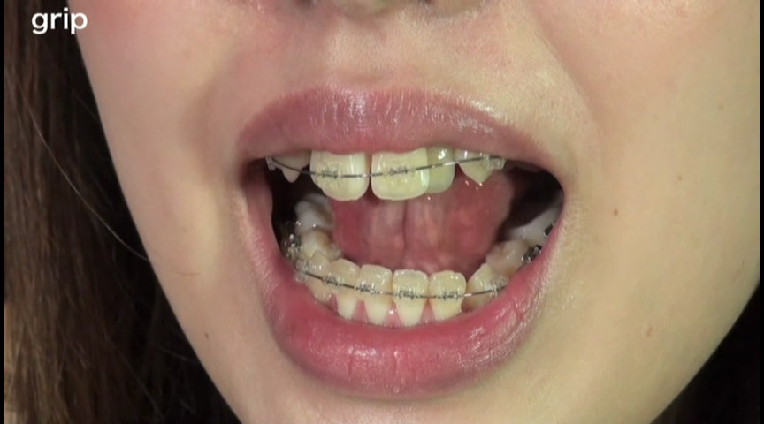 鼻フック＆開口器 唾ダラ穴剥け歯列矯正娘 | DUGAエロ動画データベース