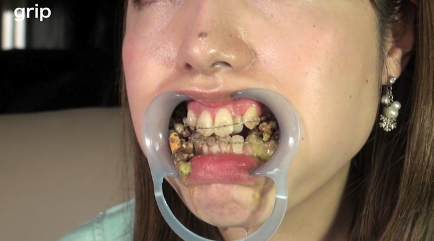 素人歯列矯正 顔面デストロイ 矯正中のリョウコちゃん 画像7