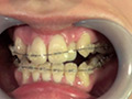 素人歯列矯正 顔面デストロイ 矯正中のリョウコちゃんのサンプル画像2