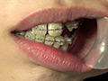 素人歯列矯正 顔面デストロイ 矯正中のリョウコちゃん 画像3