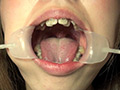 素人歯列矯正 顔面デストロイ 矯正中のリョウコちゃんのサンプル画像5
