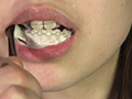 素人歯列矯正 顔面デストロイ 矯正中のリョウコちゃん 画像10