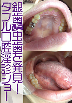 銀歯vs虫歯を発見！ダブル口腔淫診ショー