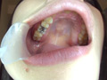 銀歯vs虫歯を発見！ダブル口腔淫診ショー サンプル画像2