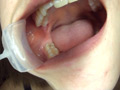 銀歯vs虫歯を発見！ダブル口腔淫診ショー サンプル画像6