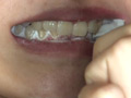 銀歯vs虫歯を発見！ダブル口腔淫診ショー サンプル画像7