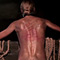 Burning pain